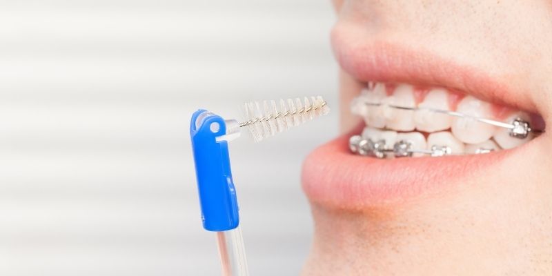 Enjuague bucal para ortodoncia