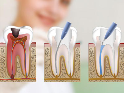 Endodoncias